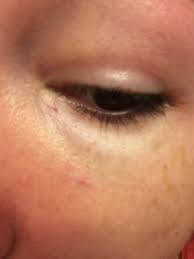 A burst blood vessel in the eyes is a relatively common problem that can have many sources. Is It Possible To Get Rid Of The Broken Capillary Under My Eye Photo