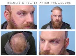 Beard hair transplant to head. See How Beard To Scalp Fue Is Performed On A Real Patient Cosmetic Town