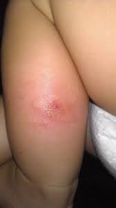 Sometimes they're even painful and feel warm, similar to an infection, says bassett. Pin On Kyler Jace 3
