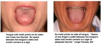 Iodine Vs Fluoride One Secret To Better Health Thyroid Health Health Health And Wellness