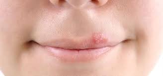 Image result for oral herpes symptoms roof of the mouth
