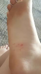 Image result for brown patches on the feet