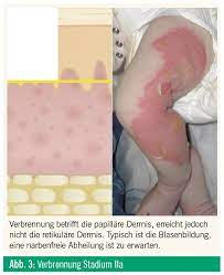 Verbrennungsverletzungen Bei Kindern Medmedia