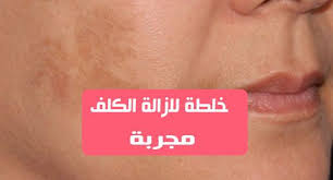 الكثير من النساء يبحثون عن خلطة لازالة الكلف مجربة الكلف هو نوع من الأمراض الجلدية ويعرف عموما بأنه زيادة في التصبغ وينتشر بين النساء اكثر من الرجال تصاب به م
