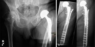 The vancouver style is the citation style used by most biomedical journals and many scientific the dental hygiene program at vancouver community college uses vancouver style in all assessment. Periprothetische Femurfraktur Springerlink