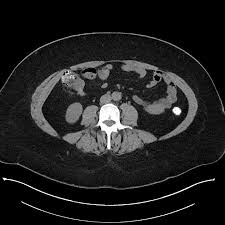 The first two portions of the small intestine are called the duodenum and the jejunum. Carcinoid Tumor Terminal Ileum Radiology Case Radiopaedia Org