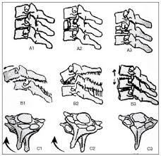 Image result for Subaxial Injury Classification Scale