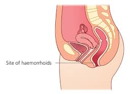 Other causes, she says, include sitting for long periods of time and not eating enough. Piles General Information Embarrassing Problems