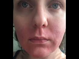 A burn from hair removal cream is a chemical burn. Boots Customer Left With Chemical Burn Like Red Marks On Her Face After Using Store S Own Hair Remo Youtube