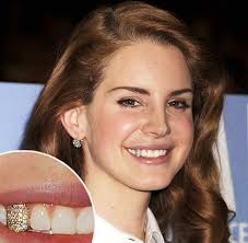 The procedure involves putting crowns on the two abutments (teeth on either side of the missing tooth). Lana Del Ray Fogekszer Http Www Merjmosolyogni Hu Sztarok Aranyfoggal Fogekszerrel Divatos Hobort Mosoly Gold Teeth Grillz Teeth Teeth