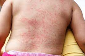 If a biting mite infestation happens anyway, there are steps that can be taken to eliminate them. Symptoms Of Dust Mite Bites Dust Mite Allergies Specialty Air