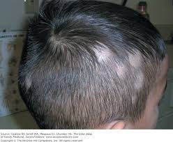 Image result for Tinea Capitis