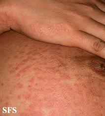 Image result for pruritic urticarial papules and plaques of pregnancy