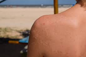 Image result for Sunburn
