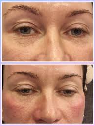 🌟Microneedling is an effective treatment for addressing fine lines,  under-eye bags, puffiness, hyperpigmentation, acne scars, and stretch  marks. When applied under the eyes, it can help reduce the appearance of  dark circles,