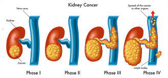 However, it only cures the disease if the. Kidney Cancer Symptoms Renal Cancer Treatment In Noida