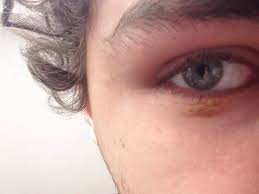 Was Ist Das Gelbe Unter Meinem Auge