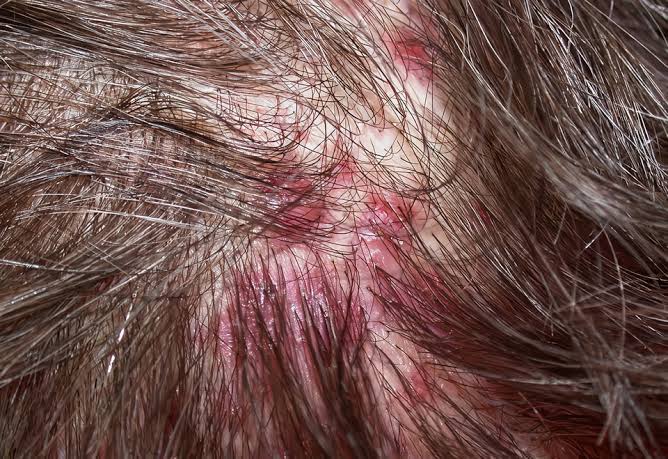 Ngứa da đầu nổi mẩn đỏ: Nguyên nhân và 5 cách xử lý