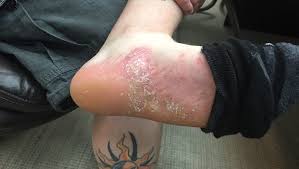 Tpi Iowa Sued By Workers Who Claim They Were Fired After On The Job Injuries