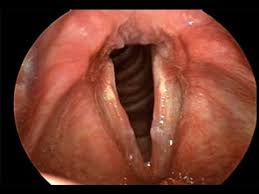Image result for Acute Laryngitis