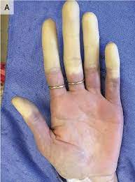 Raynaud S Phenomenon Nejm Resident 360 Meta Property Twitter Image Content Https Resident360files Nejm Org Image Upload C Fit F Auto H 120 W 120 V1538599218 U8buf4o8mgdxgmfcczjk Png Meta Property Og Image Content Https