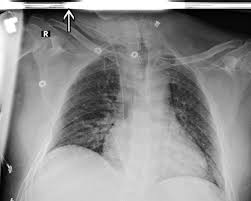 Comparison of stent conformity in curved vascular models among iv fdct and digital radiography (dr) in an in vitro study. Pictorial Review Of Digital Radiography Artifacts Radiographics