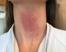It frequently results in and is the most common cause of hyperthyroidism. Anyone Develop A Rash On Their Neck After An Armour Dosage Increase I Went From 1 5 Grains To 2 Grains 10 Days Ago This Just Started Last Night And I Cannot Figure