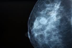 stage 3 means that the cancer has spread from the breast to lymph nodes close to the breast or to the skin of the breast or to the chest wall. Stage 0 Breast Cancer Treatment Options Onco Com