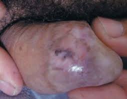 Image result for balanoposthitis