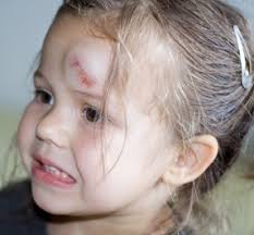 Achten sie dabei auf äußerliche anzeichen ist ein baby vom bett gefallen, reagieren die meisten eltern völlig panisch. Muss Ein Kind Nach Sturz Auf Den Kopf Gerontgt Werden Mta R De