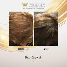 It takes years of diligent work to reduce your hair growth significantly. W Clinic Dr Cyj Hair Filler First Hair Filler In The World That Function With Sustained Released Peptide Technology It Effectively Helps In Decrease Hair Loss Promoting Hair