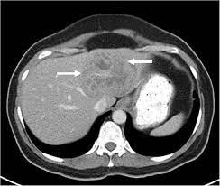 Identifying these lesions on ct scan performed for nonspecific symptoms can help identify interval crc and improve patient outcome. Pre Treatment Ct Scan Of The Abdomen Showing A Large Hypodense Mass In Download Scientific Diagram