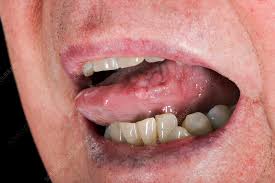 Image result for papillomavirus tongue)