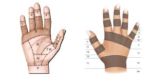 Image result for Elson Extensor Tendon Test