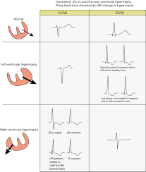 ecg in left ventricular hypertrophy lvh criteria and