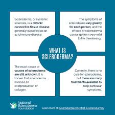 Image result for Connective Tissue Disorder