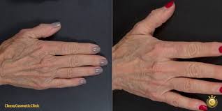 Image result for Hand Injection