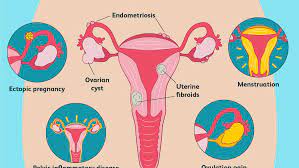 A ct scan showed a tumor on my left ovary. Ovary Pain Causes Treatment And When To See A Doctor