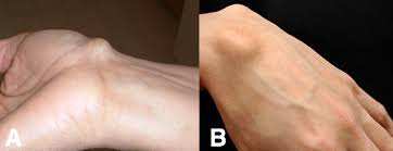 Read about recovery, rehab, surgery, and symptoms of an achilles tendon physiotherapy can expedite recovery time. Ganglionic Cysts Pathophysiology Management Teachmesurgery