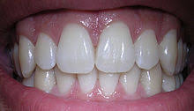 Could a tooths root split? answered by dr. Oral Hygiene Wikipedia