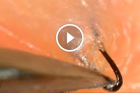 Ingrown hair does not choose whom to affect and both men and women get them in equal measures. This Ingrown Hair Removal Video Is Feels Stay At Home Mum