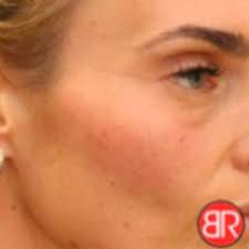 Green toning Tratamiento para Pecas, Melasma y tono desigual