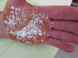 Image result for Anhidrosis