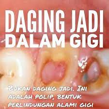 Polip Pulpa Polip Pulpa Atau Pulpa Polip Atau Pulpitis Hiperplasia Kronis Adalah Pertumbuhan Sel Baru Dari Ruang Pulpa Gigi Sebagai Reaksi Peradangan Kronis Y