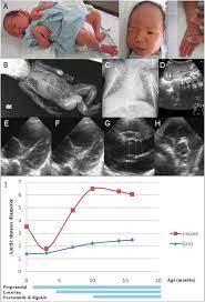Losartan In Combination With Propranolol Slows The Aortic Root Dilatation In Neonatal Marfan Syndrome Pediatrics Neonatology