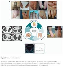 Image result for Yellow nail syndrome feet