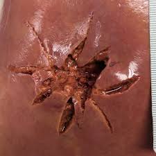 Maybe you would like to learn more about one of these? Gunshot Wound To Liver Radiology Case Radiopaedia Org
