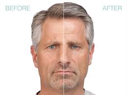Both last for approximately four months, with some variation between patients. Botox Dysport Xeomin Jeuveau Dermatology Specialists Of Naples Naples Fl Botox
