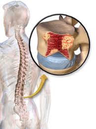 A cancerous tumor is a body of tissue consisting of cells that have undergone genetic changes, causing them to grow in an uncontrolled way. Primary And Secondary Bone Cancers Symptoms And Treatment Earth S Lab