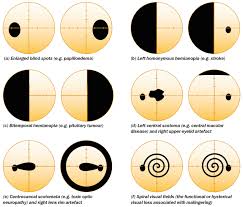 Community Eye Health Journal Visual Field Testing For